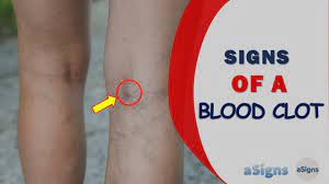 Can Wearing A Knee Brace Cause Blood Clots