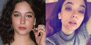 She's been making a name for herself for a while, even though she's still so young. Matilda De Angelis Of The Undoing Talks About Having Acne Insider
