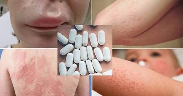 Xử lý khi bị dị ứng: Dị ứng thuốc nên uống gì? - Nhà thuốc FPT Long Châu