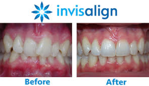 Invisalign could be your best option! Have You Heard About Invisalign Learn How To Discreetly Straighten Your Teethdr Jacquie