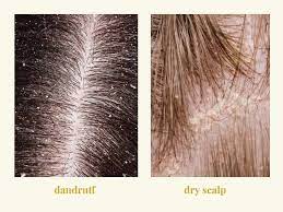 Dandruff Vs Dry Scalp Causes Symptoms And Best Treatments Dry Scalp Dry Scalp Vs Dandruff Dry Scalp Patch