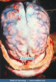 Image result for Neurosyphilis