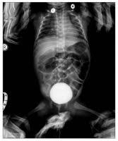 Image result for Voiding Cystourethrogram