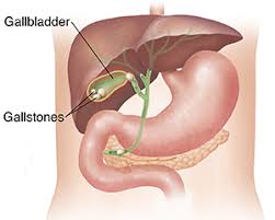 Possible Gallstone With Biliary Colic Presumed
