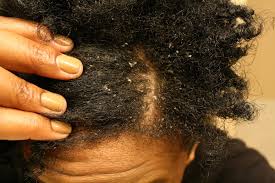 Even hair oil virgins can get a formula that's right for them on the first try, because prose customizes each bottle of hair oil specifically for the purchaser. How To Get Rid Of That Annoying Dandruff Situation And P S You Re Not Alone Capital Lifestyle