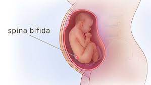 Spina Bifida Surgery During Pregnancy Illustrations Children S Hospital Of Philadelphia