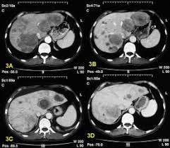 Metastazy V Pecheni Simptomy Lechenie Metastaz V Pecheni Skolko Zhivut S Metastazami Pecheni Mts Pecheni