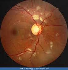 Image result for HIV Retinitis