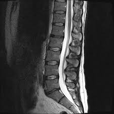 Diese fragestellung wird in diesem artikel ausführlich beantwortet. Magnetresonanztomographie Der Wirbelsaule Ct Mrt Institut Berlin