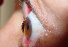 Keratoconus is passed from parents to children in approximately 25% of cases. What Is Keratoconus Area Oftalmologica Avanzada