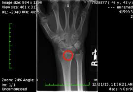 Check spelling or type a new query. What A Broken Wrist Taught Me About Drawing Skills Vitruvian Fine Art Studio