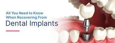 Everything You Need To Know About Dental Implant Recovery Hiossen Implant