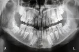 X Ray Of Jaw With Teeth And Milk Teeth X Ray Dental Dentist