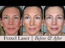 Check spelling or type a new query. Fraxel Face Laser Before After 3 Month Update Youtube