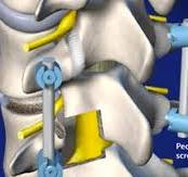 Transforaminal Lumbar Interbody Fusion (TLIF) - Hermitage ...