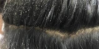 Try These Easy Home Remedies To Get Rid Of Lice Eggs The sulphur content in onion has a pungent smell that.