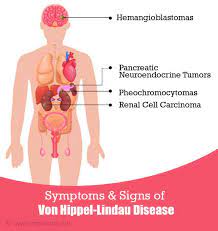 Von Hippel Lindau Disease Rare Genetic Disorder Causes Symptoms Diagnosis Treatment And Prognosis