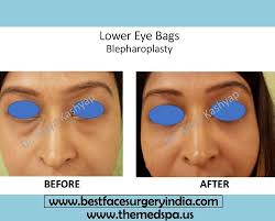 Myths And Facts About Blepharoplasty Surgery Eyelid Surgery Eyelid Lift Upper Eyelid