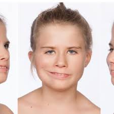 Result of " smile surgery " with frontal facial view and oblique views...