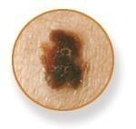 A skin cancer can appear suddenly overnight or be very slow growing or appear in a previously benign lesion. Skin Cancer Awareness What Is Skin Cancer Bellaire Dermatology