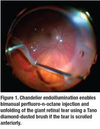 Treatment can reduce the risk of a tear progressing to a retinal detachment to about one percent. Giant Retinal Tear Surgery Made Simple