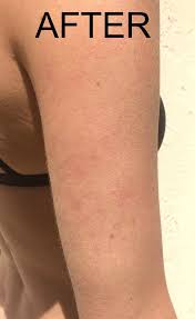 Initially small white spots on skin appear which grow in size with time. How To Heal Keratosis Pilaris With Diet Pure And Simple Nourishment