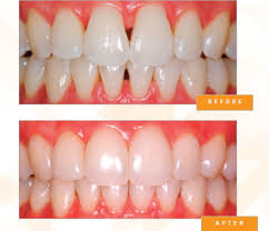 How much should this cost me, for the people who have had it done. Bioclear Treatment In Se Calgary Bioclear Treatment Near You In Mckenzie Towne