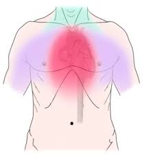 Image result for Angina Pectoris