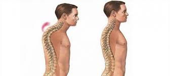 как избавиться от горба на спине в домашних условиях Gorb Na Spine Prichiny Vozniknoveniya Lechenie I Profilaktika Zabolevaniya Blog Drevmass