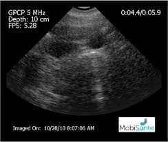 An ultrasound is an important next step even if you're considering abortion. Free Pregnancy Test And Sonogram Pregnancy Test