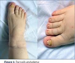 Image result for Yellow nail syndrome feet