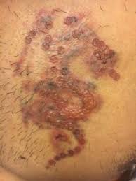 It is a very safe process, however, there is a particular aftercare protocol to follow in order to maximize your healing. Medical Aspects Of Laser Tattoo Removal The Skin Structure