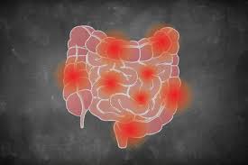 Ulcerative Colitis Symptoms You Should Never Ignore Creakyjoints
