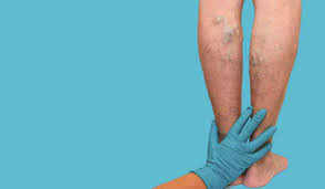 La trombosis venosa profunda es un coágulo sanguíneo que se forma en una vena profunda en el cuerpo, como piernas o los muslos. Cinco Puntos Que Debes Conocer Sobre La Trombosis Salud Para Todos
