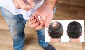 Final thoughts on natural treatments for thinning hair. Hair Loss Treatment For Men Try Finasteride Express Co Uk