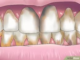 Technically you cannot reverse all the effects of advanced periodontal disease, however, you can stop it and mitigate the damage already done. 3 Ways To Reverse Dental Bone Loss Wikihow