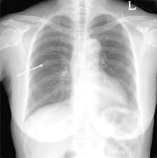 Image result for Air Bronchogram