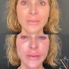 Leeza Edmundson Smith, Aesthetic Injector (@myinjectorleeza) • Facebook