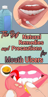 10 Best Treating Mouth Ulcers Canker Sores Ideas Mouth Ulcers Mouth Sores Canker Sore