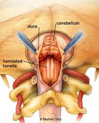 Chiari Decompression Surgery Mayfield Brain Spine Chiari Chiari Malformation Surgery