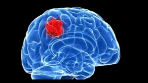 Check spelling or type a new query. Who S New Classification Of Central Nervous System Cns Tumours Students 4 Best Evidence
