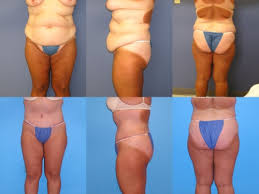 It should not be used as an alternative to weight loss. Swelling After Tummy Tuck Surgery Cherup Lori Drcherup Com
