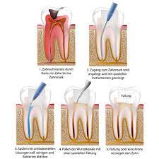 Ist eine wurzelkanalbehandlung nicht schmerzhaft? Was Wird Bei Einer Wurzelbehandlung Gemacht Kostenfalle Zahn