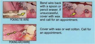 Gently pull your cheek away from the area and dry the area where you will cut the wire. Emergency Info Chestnut Dental Bedford Massachusetts