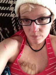 42-Year-Old Woman Has Survived 86 Skin Cancer Surgeries: 'I'm Gonna Win  This'