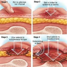 Pressure Ulcers Staging Geriatric Nursing Wound Care