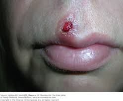 Image result for syphilis ulcer