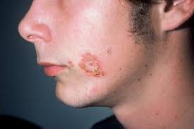 CONTAGIOUS SKIN RECOGNITION