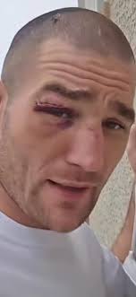 Who had Dricus by face-lift and blood loss?