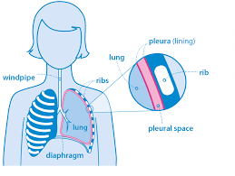 mesothelioma is a type of cancer in which tumors form in the tissue that lines the lungs, heart, stomach, and other organs. What Is Mesothelioma British Lung Foundation